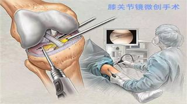 关节镜基础知识